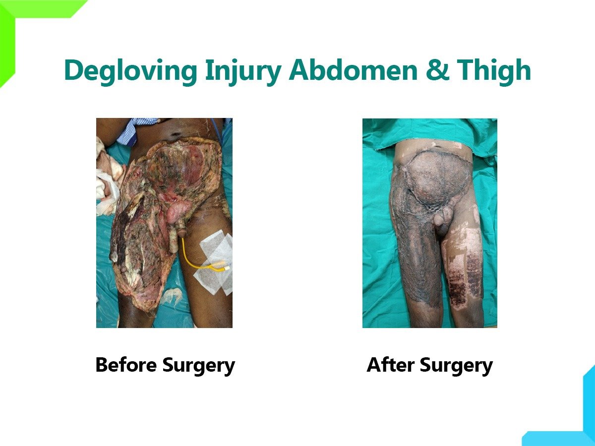 Degloving Injury Degloving Injury