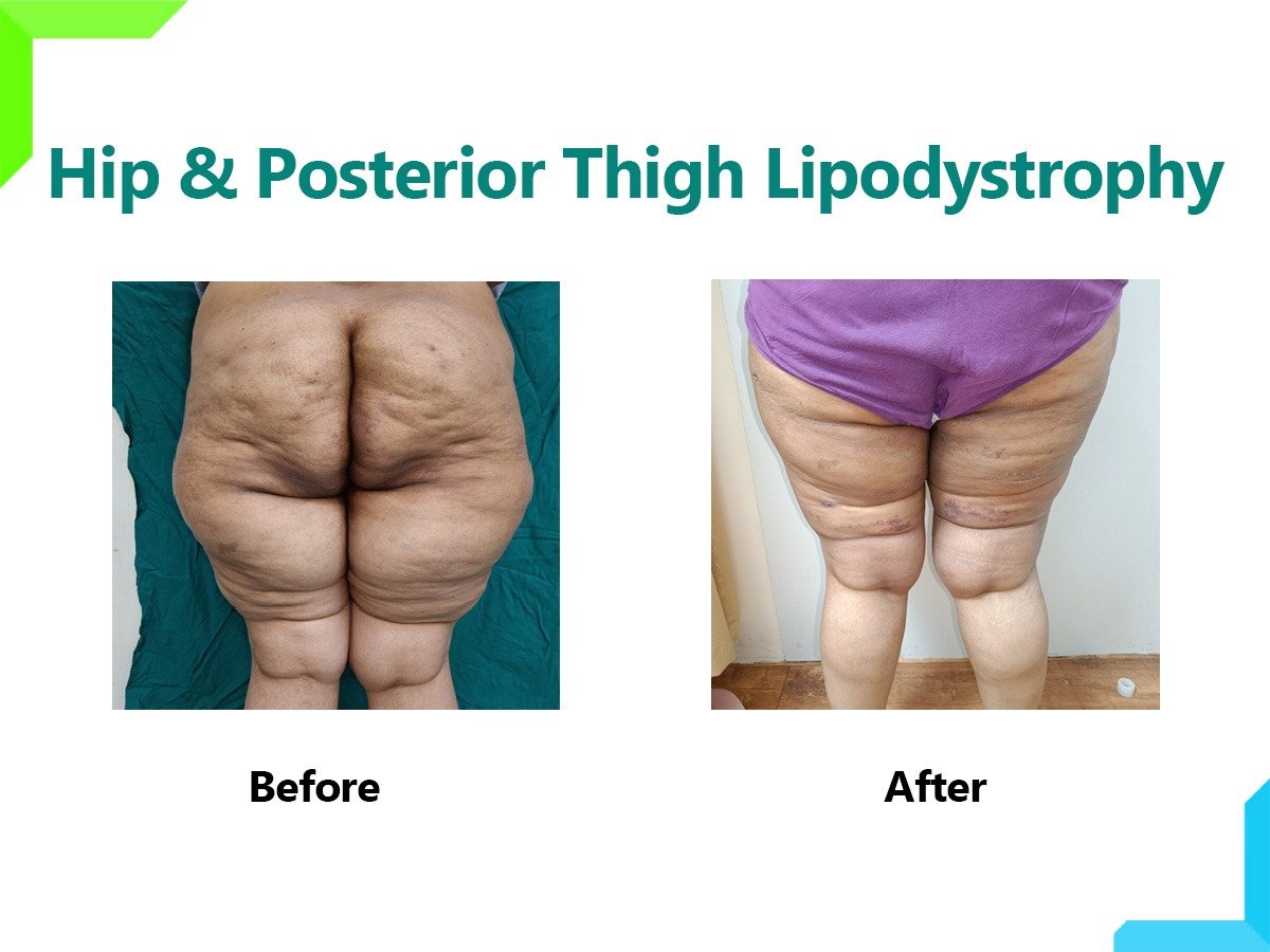 Hip and Posterior Thigh Lipodystrophy Hip and Posterior Thigh Lipodystrophy