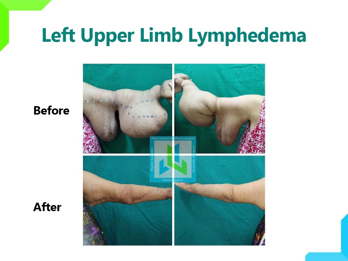 Limb Lymphedema Limb Lymphedema