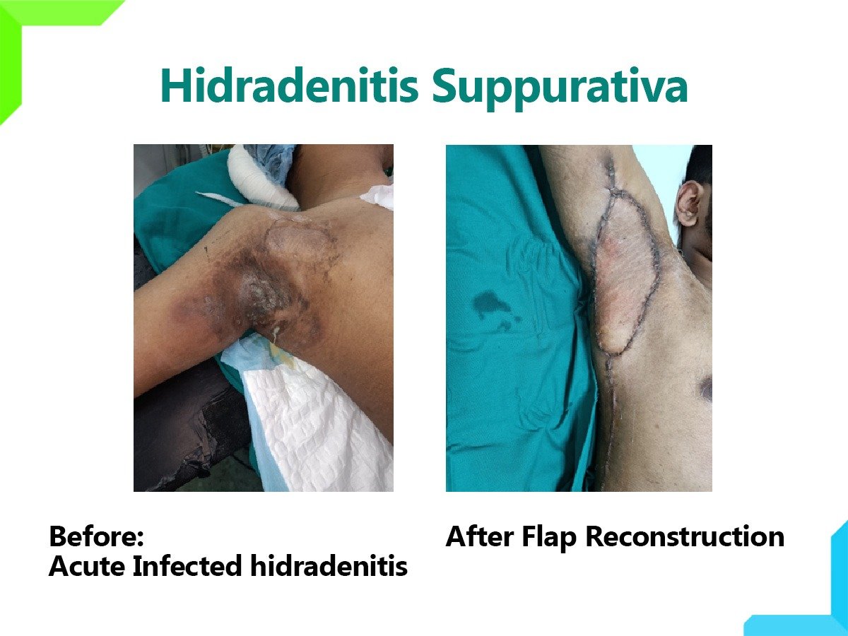 Hidradenitis Suppurativa Hidradenitis Suppurativa