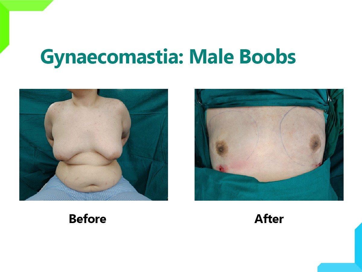Gynaecomastia Gynaecomastia