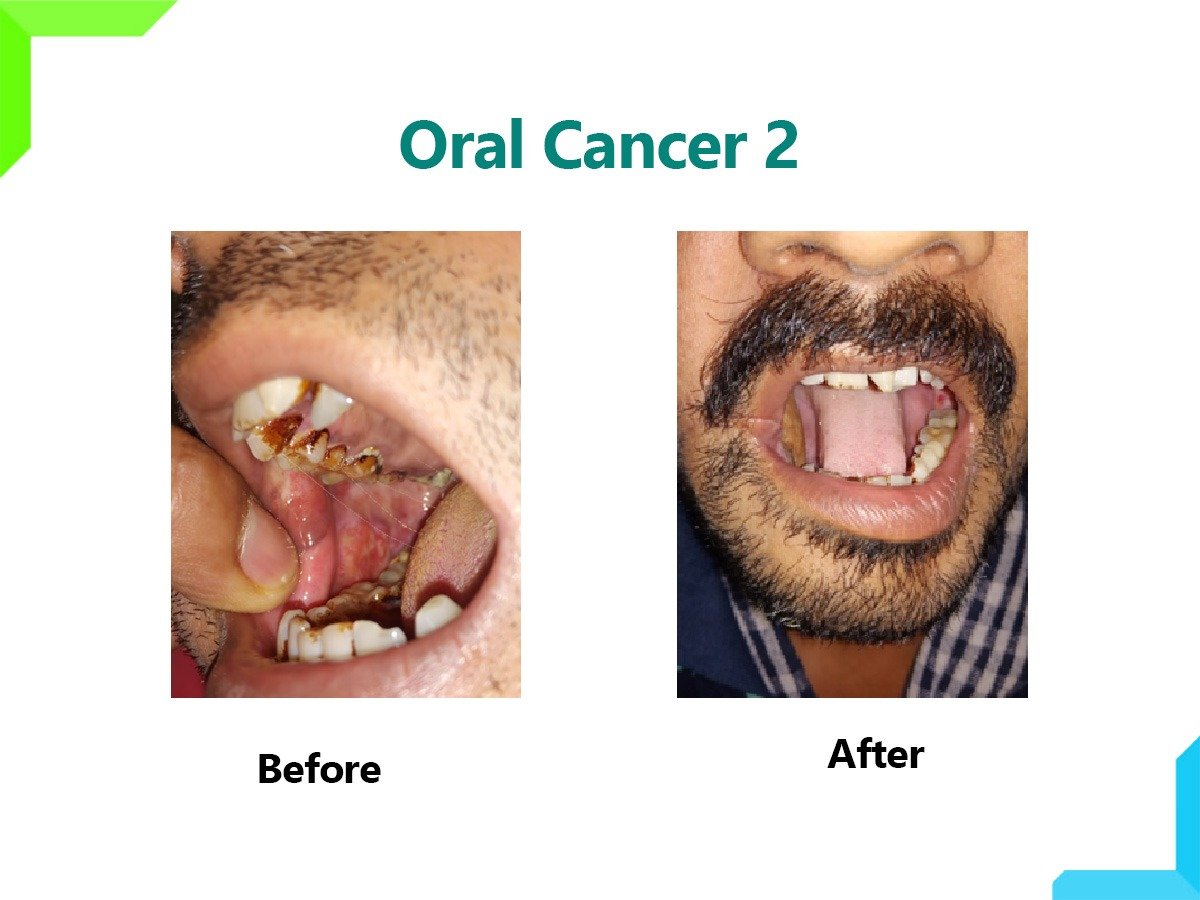Oral Cancer Oral Cancer