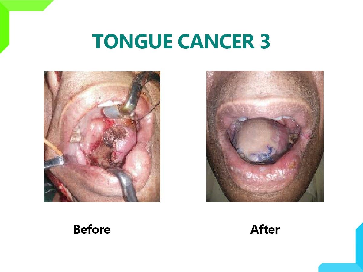 Tongue Cancer Tongue Cancer