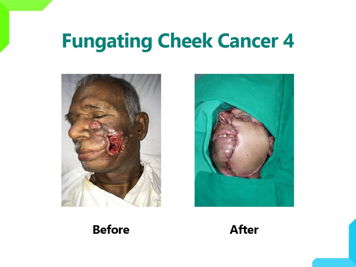 Fungating Cheek Cancer Fungating Cheek Cancer