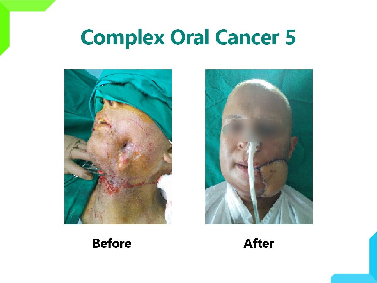 Oral Cancer Oral Cancer