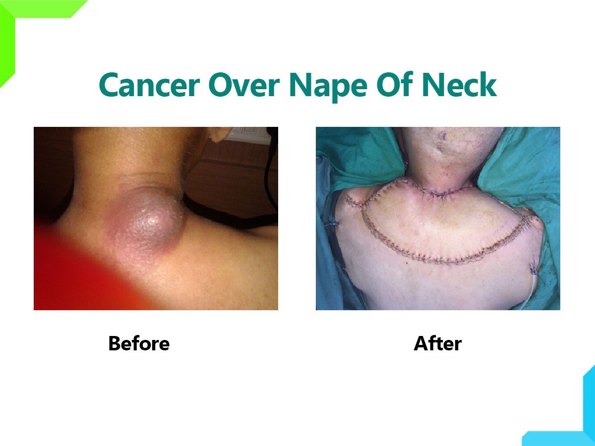 Cancer Cancer