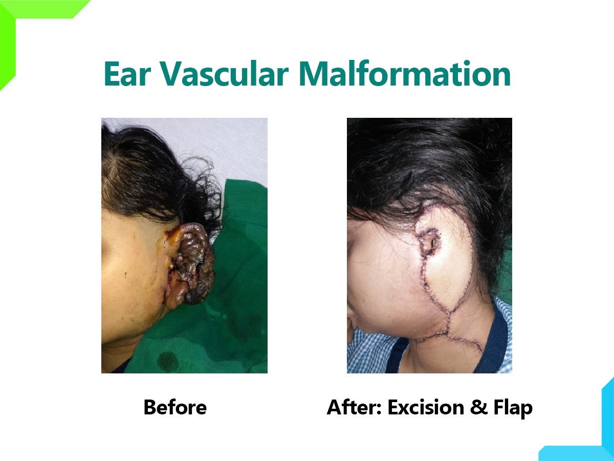 Ear Vascular Malformation Ear Vascular Malformation