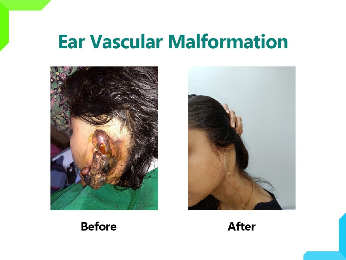 Ear Vascular Malformation Ear Vascular Malformation