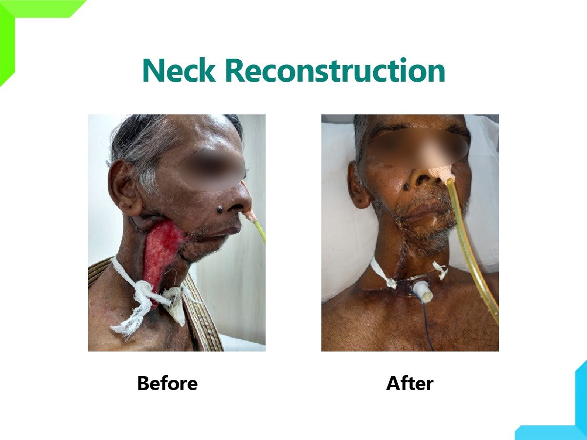 Neck Reconstruction Neck Reconstruction