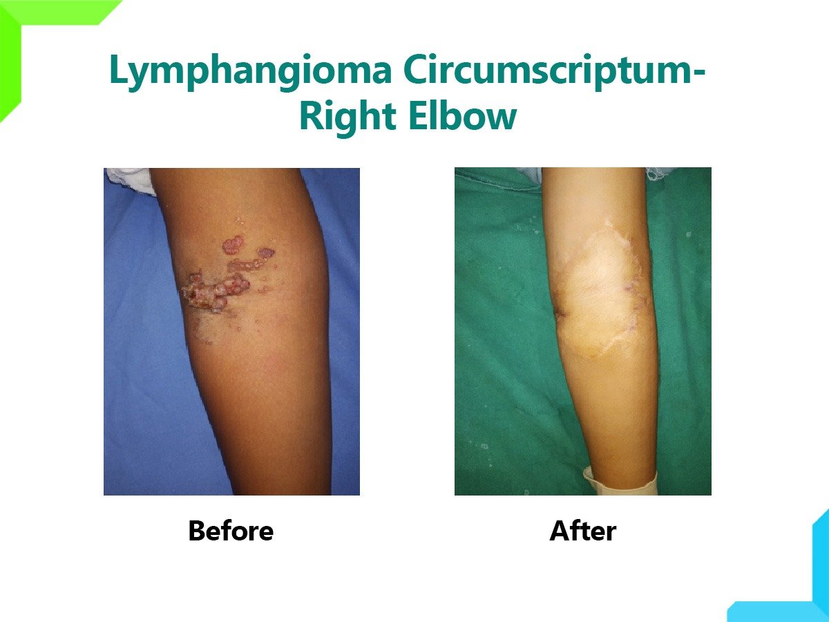 Lymphangioma Circumscriptum Lymphangioma Circumscriptum