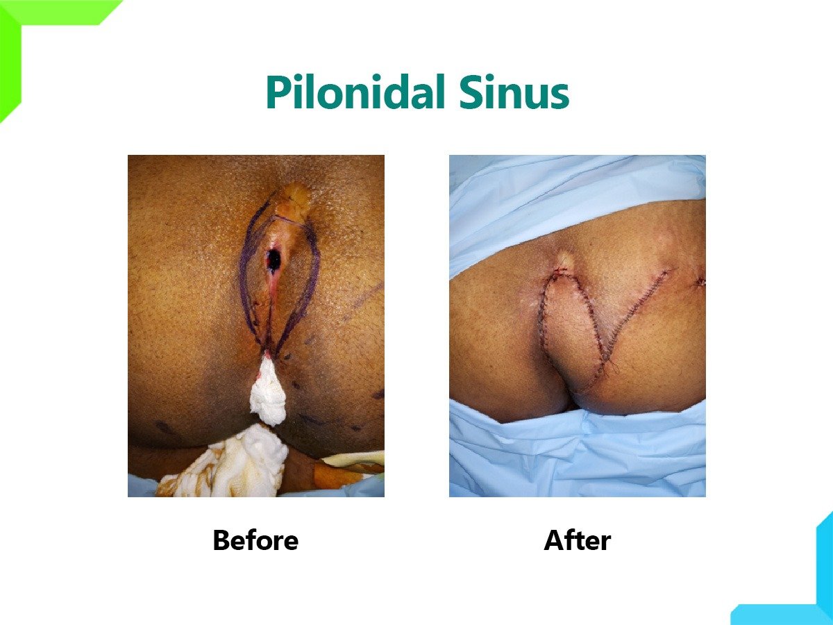Pilonidal Sinus Pilonidal Sinus