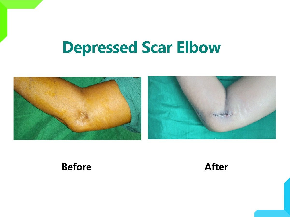 Depressed Scar Elbow Depressed Scar Elbow