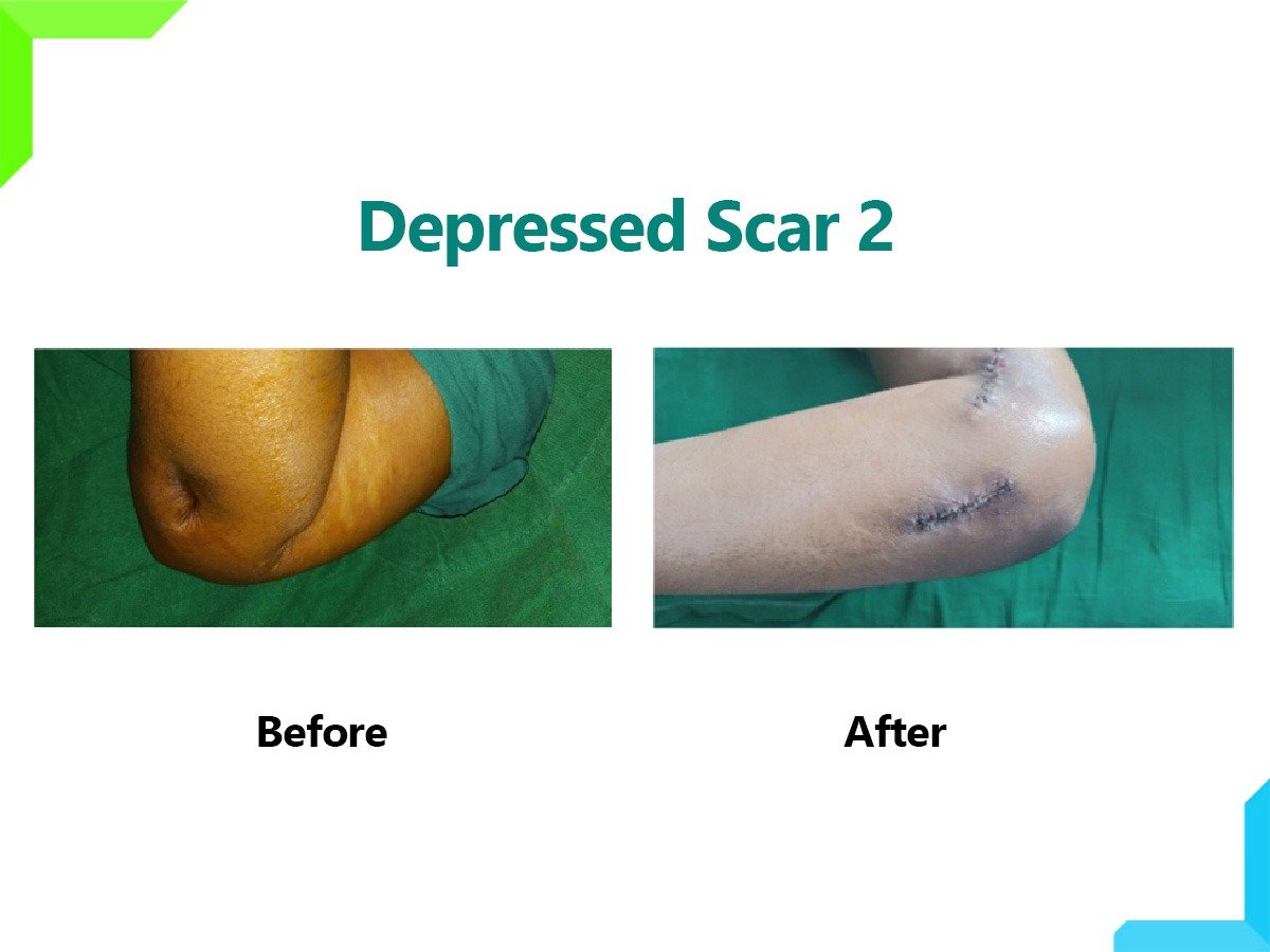 Depressed Scar Depressed Scar