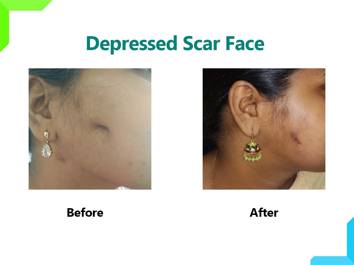 Depressed Scar Face Depressed Scar Face