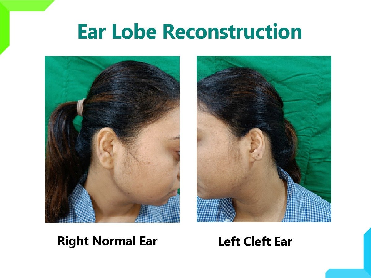 Ear Lobe Reconstruction Ear Lobe Reconstruction