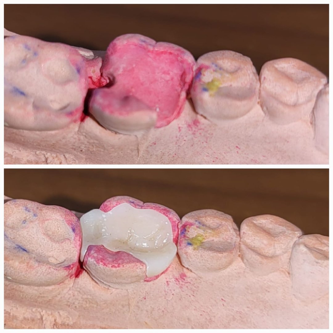 Least invasive zirconia inlay for coverage of defect , stronger and esthetically pleasing Least invasive zirconia inlay for coverage of defect , stronger and esthetically pleasing