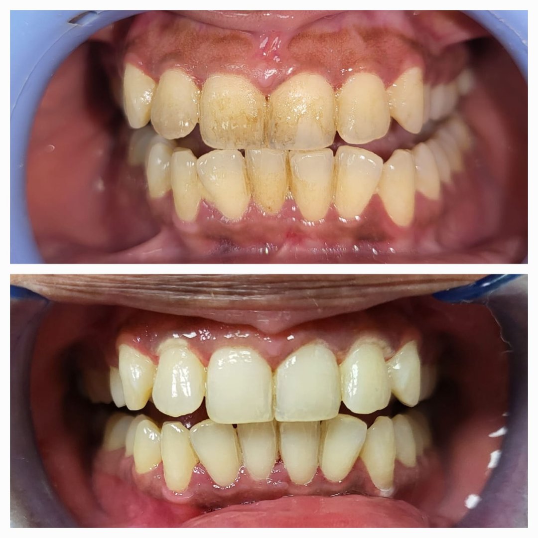 Single visit laser teeth whitening Single visit laser teeth whitening