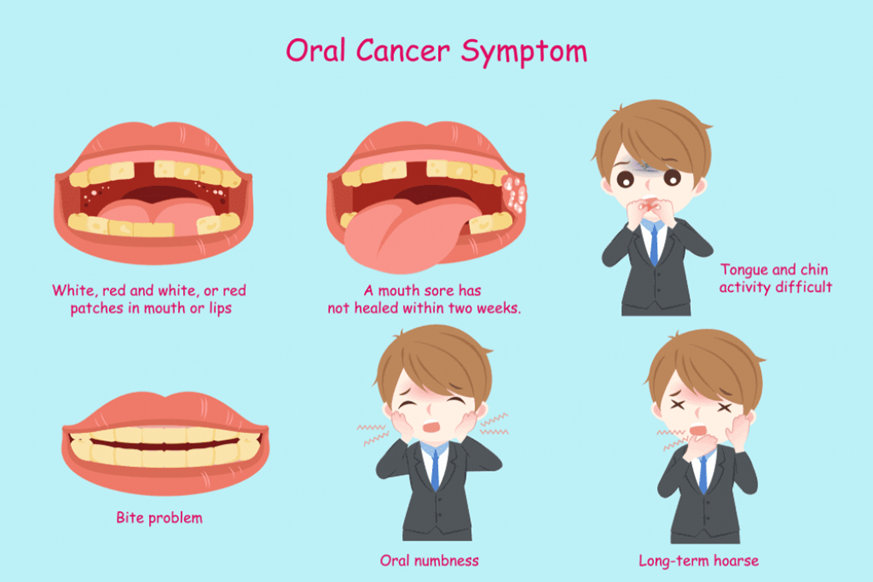 oral cancer treatment in Bangalore