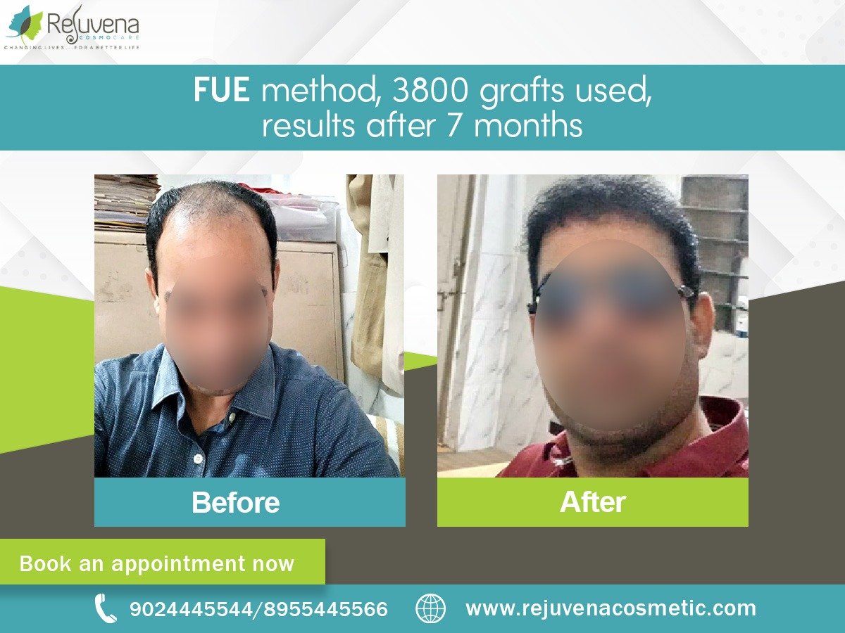 FUE method, 3800 grafts used, results after 7 months FUE method, 3800 grafts used, results after 7 months