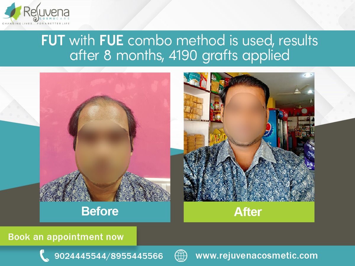 FUT with FUE combo method is used, results after 8 months, 4190 grafts applied