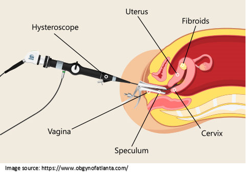 Hysteroscopy