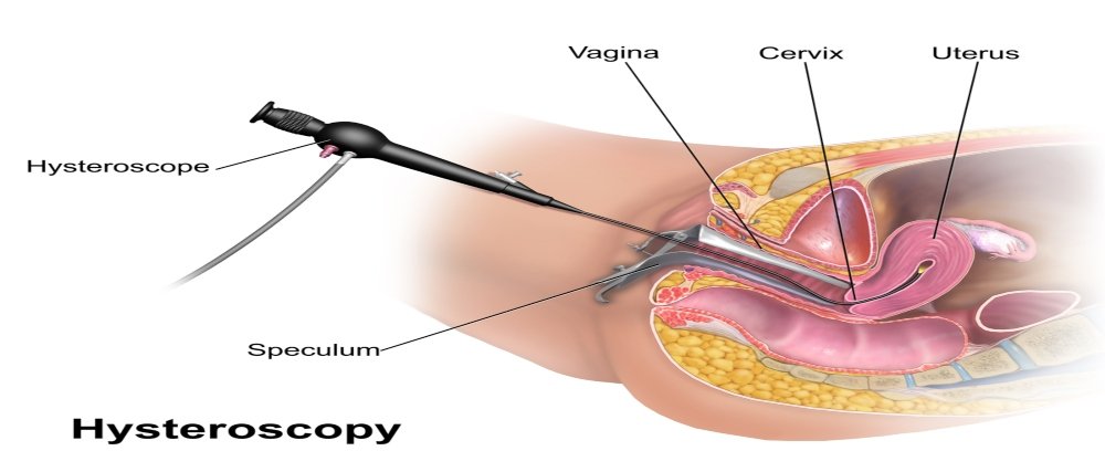 Hysteroscopy treatment in Mumbai Hysteroscopy treatment in Mumbai