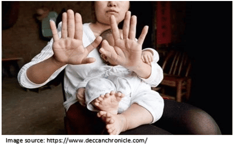 Nonsyndromic Polydactyly
