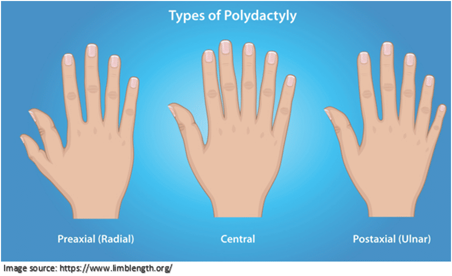 What is Polydactyly? | Dr. Leena Jain