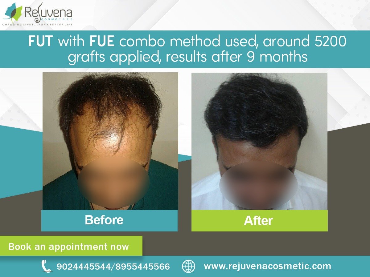 FUT with FUE combo method used, around 5200 grafts applied, results after 9 months FUT with FUE combo method used, around 5200 grafts applied, results after 9 months