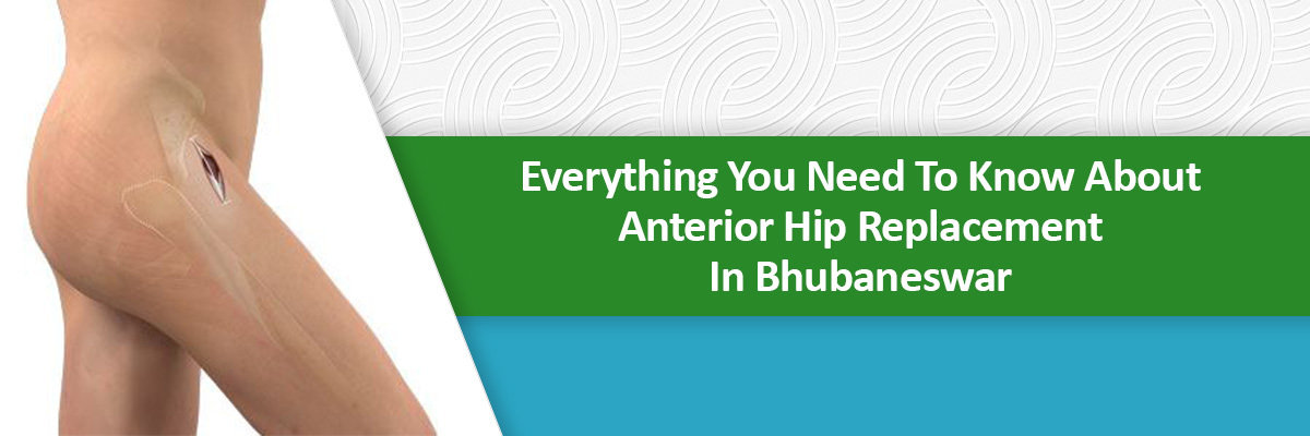 Hip Replacement Hip Replacement