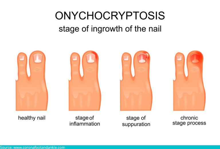 Onychocryptosis