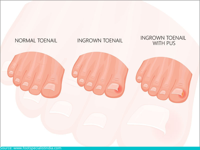 ingrown toenail