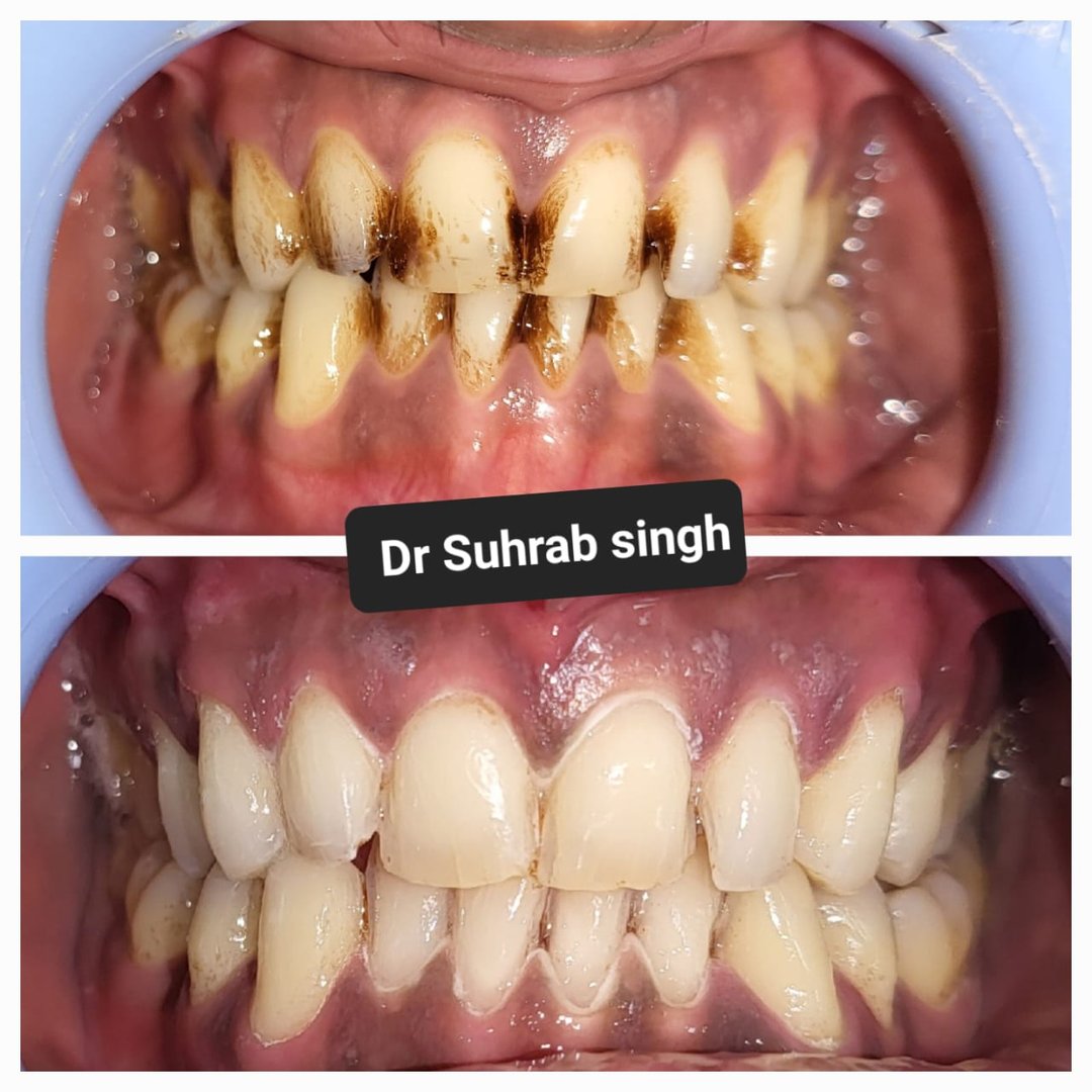 Single visit laser teeth whitening procedure Single visit laser teeth whitening procedure