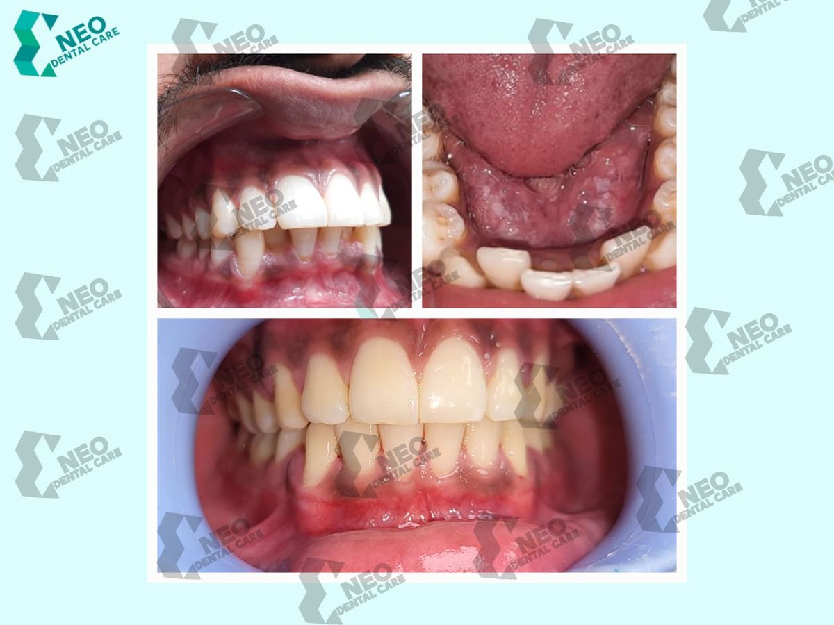 Orthodontic correction