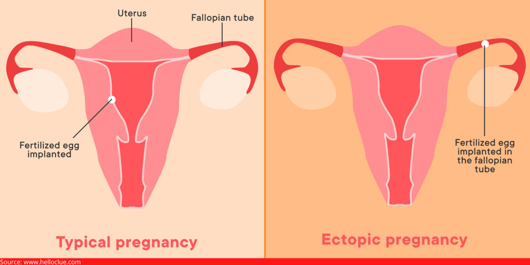  ectopic pregnancy