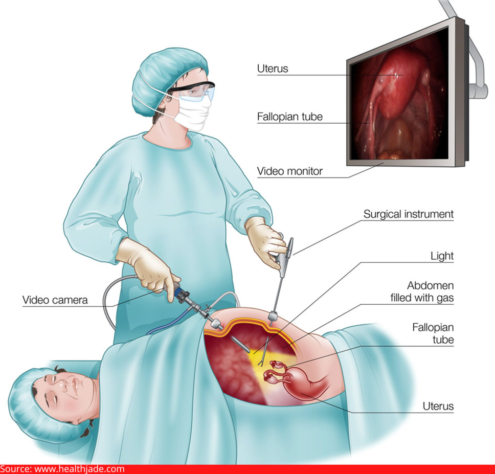  ectopic pregnancy