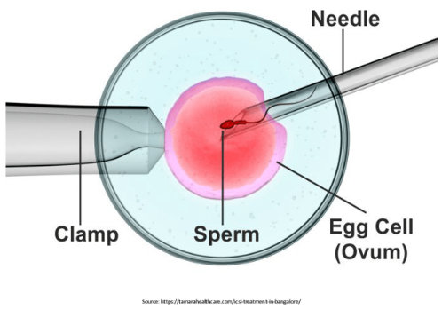 icsi treatment