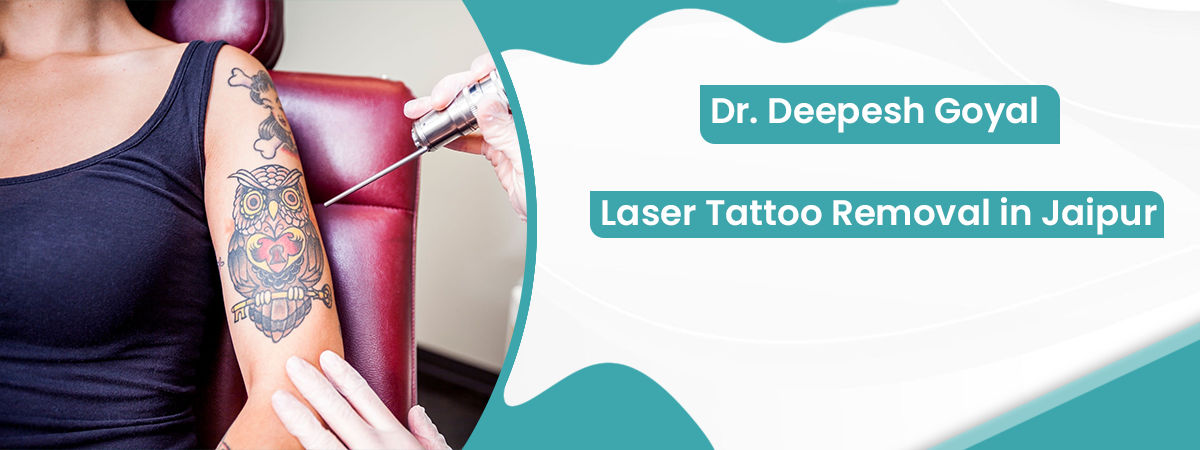 Permanent Laser Tattoo Removal Treatment Cost, Andheri, Mumbai