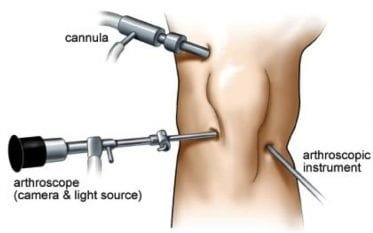 Knee Arthroscopy | Glenelg Orthopaedics