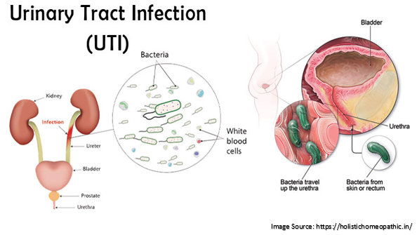 Urinary tract infections