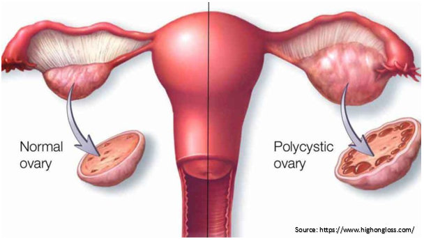 Urinary tract infections