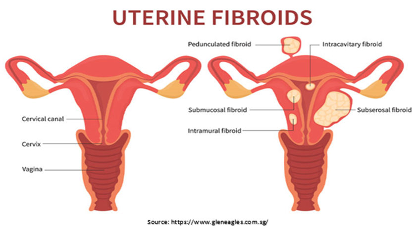 Fibroids