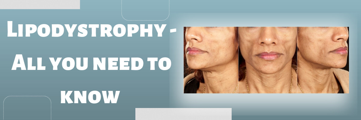 Lipodystrophy Lipodystrophy