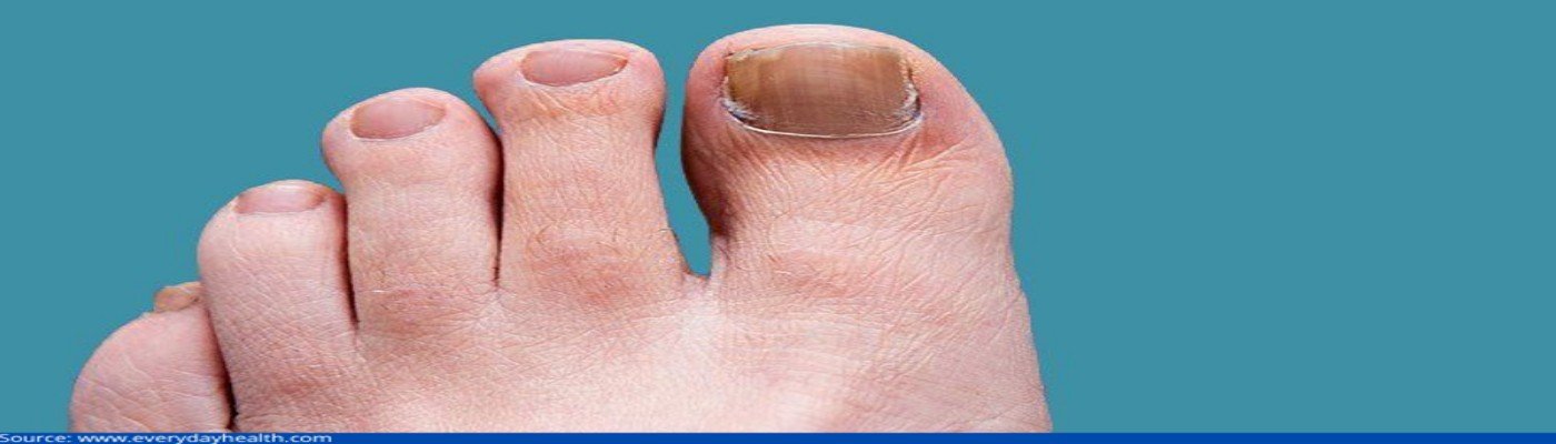 Toe Nail Fungus Treatment - Laserase Bolton - The Laser Specialists