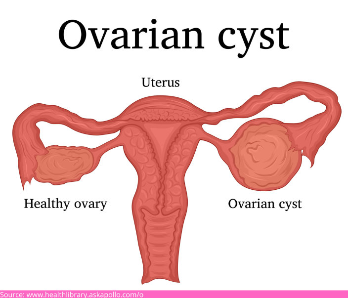 Ovarian cysts