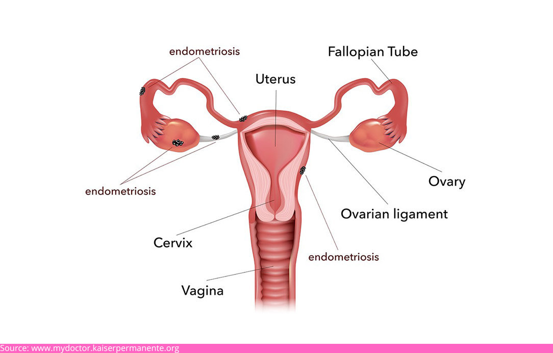 Endometriosis 