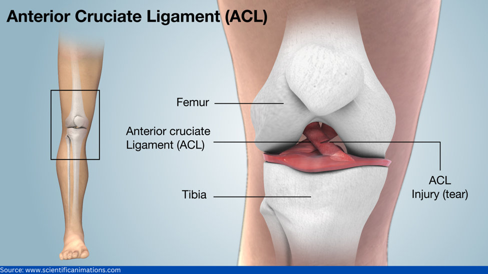 Anterior Cruciate Ligament (ACL) Tears