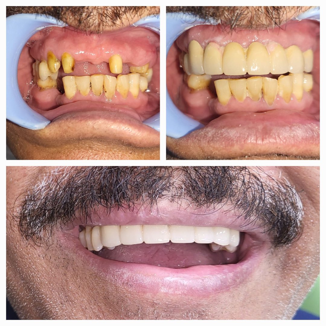 Rehabilitation of aacidental/ traumatic loss of teeth using dmls bridgework Rehabilitation of aacidental/ traumatic loss of teeth using dmls bridgework