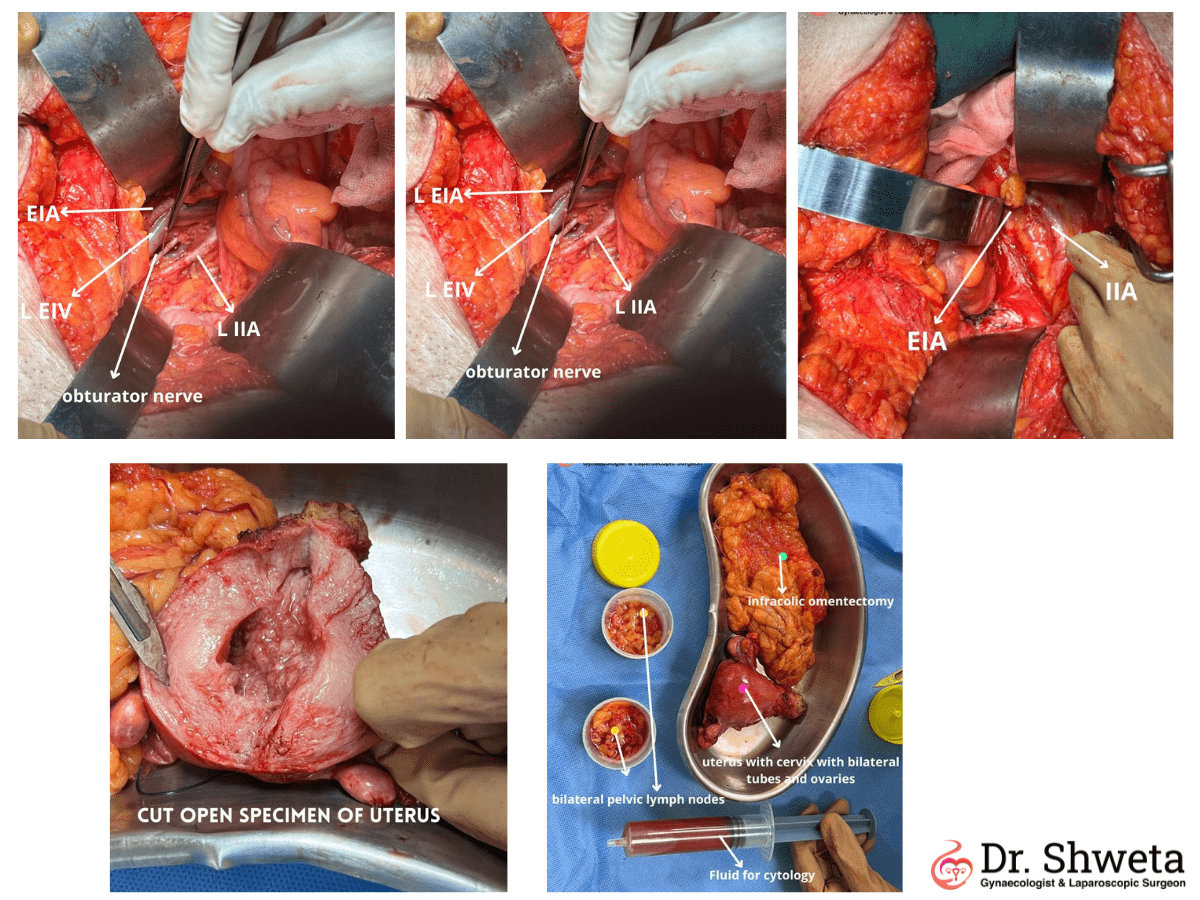 Endometrial Cancer Endometrial Cancer