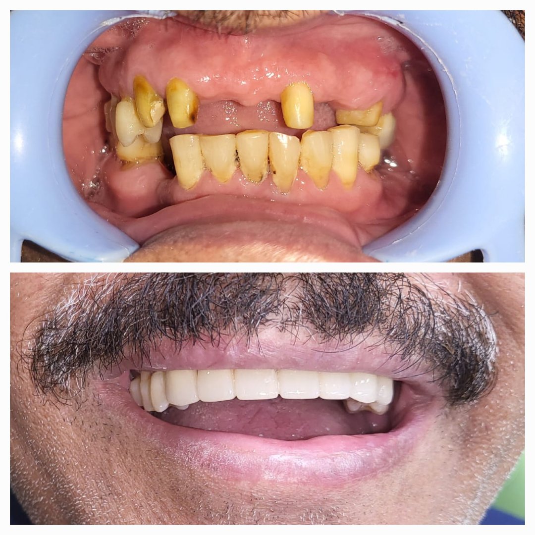 Smile makeover using all ceramic crowns Smile makeover using all ceramic crowns